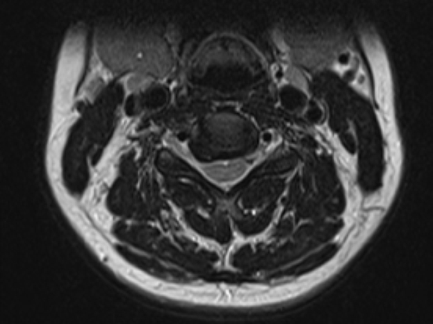 Fig 2 – (25 Nov 2019): Axial Cervical MRI C4/5 Disc Space