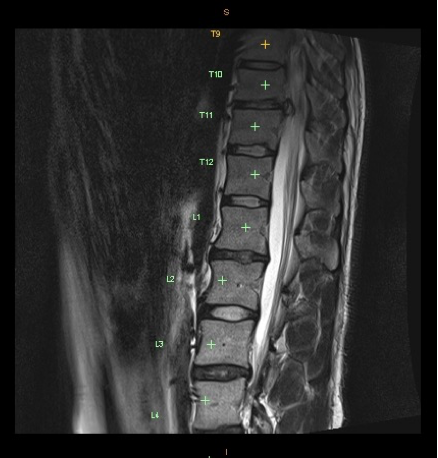 Thoracic-Spine-T2-Mid-Sagittal