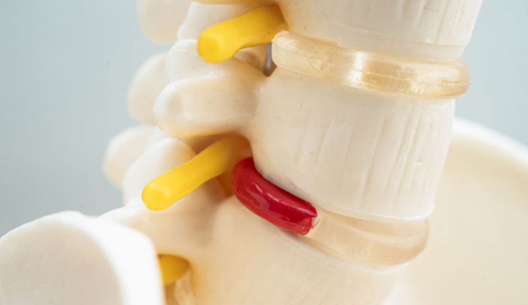 can a chiropractor fix bulging disc?