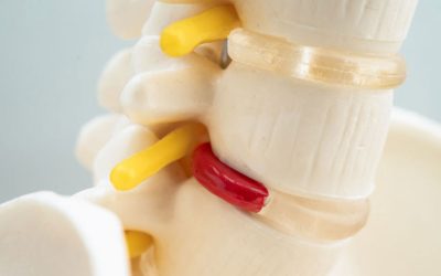 Can a Chiropractor Fix a Bulging Disc, Herniated Disc or Disc Protrusion?